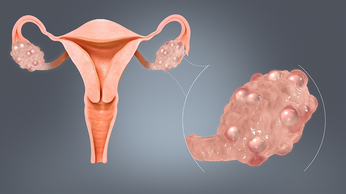 다낭성 난소 증후군 미성숙 난포를 이용한 임신 1