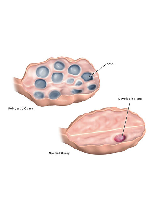 다낭성 난소 증후군 – 원인, 증상, 치료