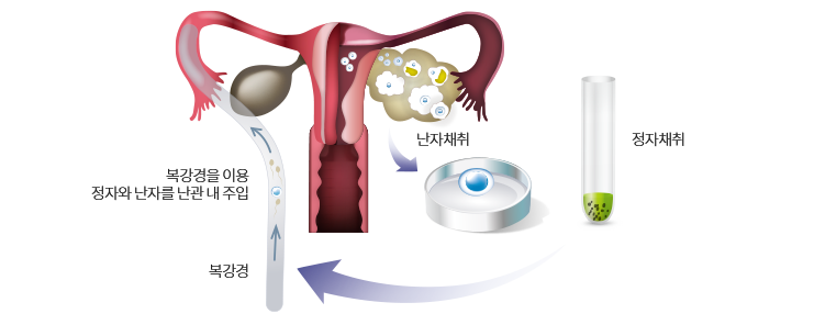 배우자 난관 내 이식 1