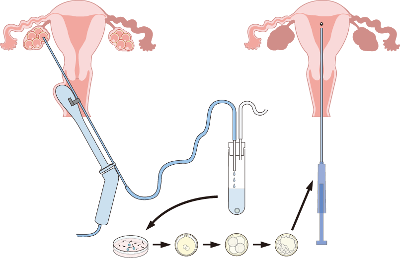 체외수정 시험관아기IVF 1